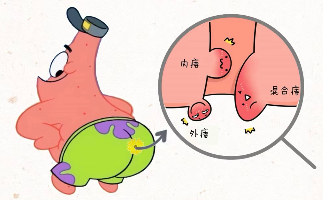 专家话科普——常见肛肠疾病